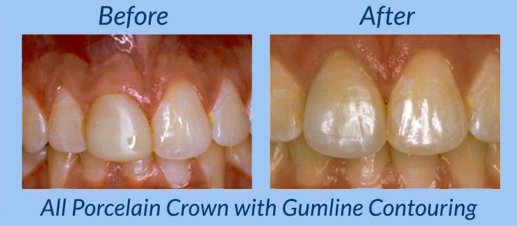 All Porcelain Crown with Gumline Contourimg