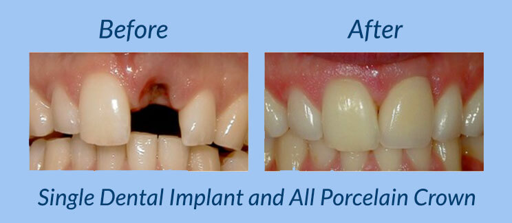 Single Dental Implant and All Porcelain Crown