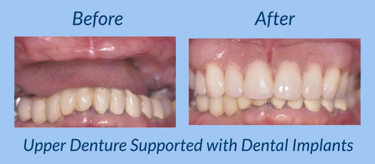 Upper Denture Supported with Dental Implants