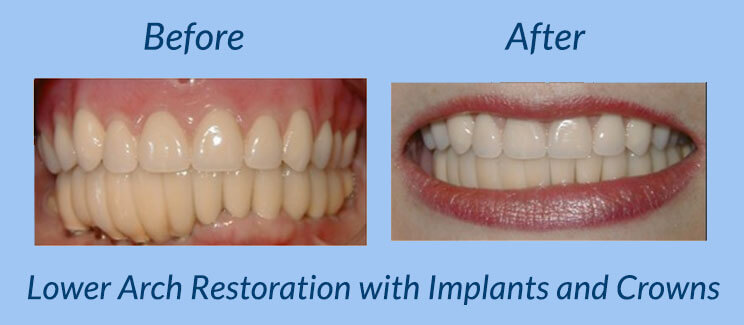 Lower Arch Restoration with Implants and Crowns