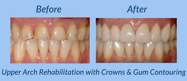 Upper Arch Rehabilitation with Crowns & Gum Contouring