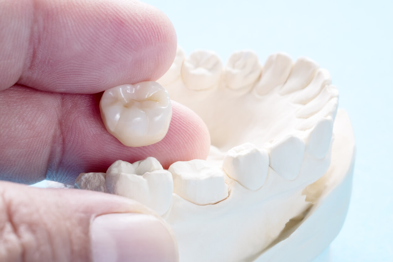 Different Types of Dental Crowns A&R Advanced Dental