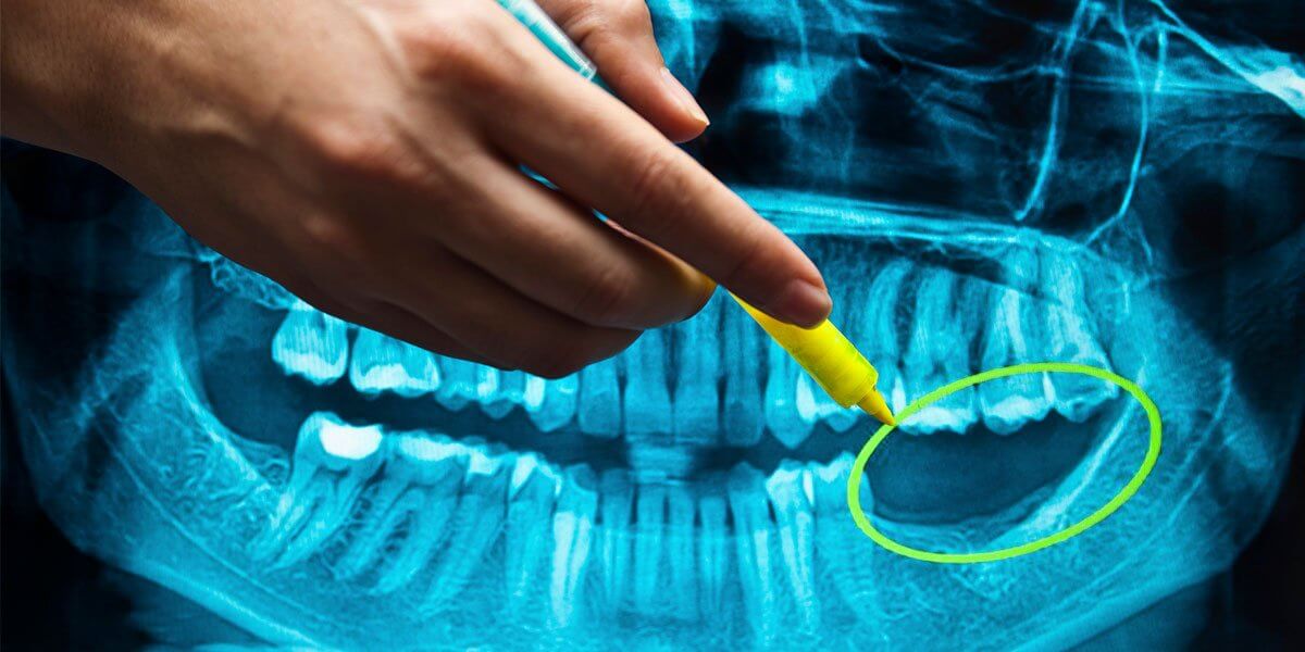 A Step by Step Guide to Dental Implants