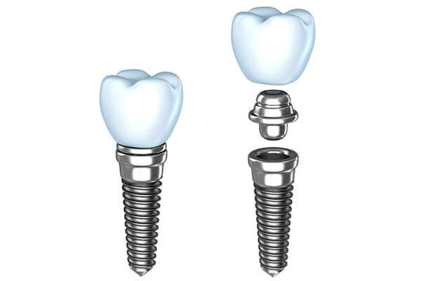 Single Tooth Dental Implants in Pomona & Brooklyn