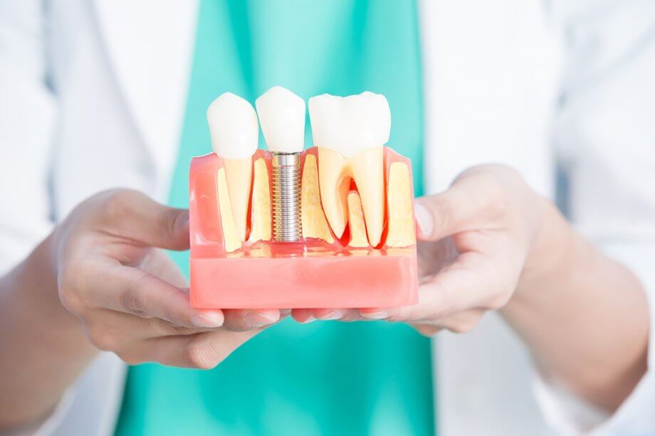 woman's hands holding a model of a dental implant