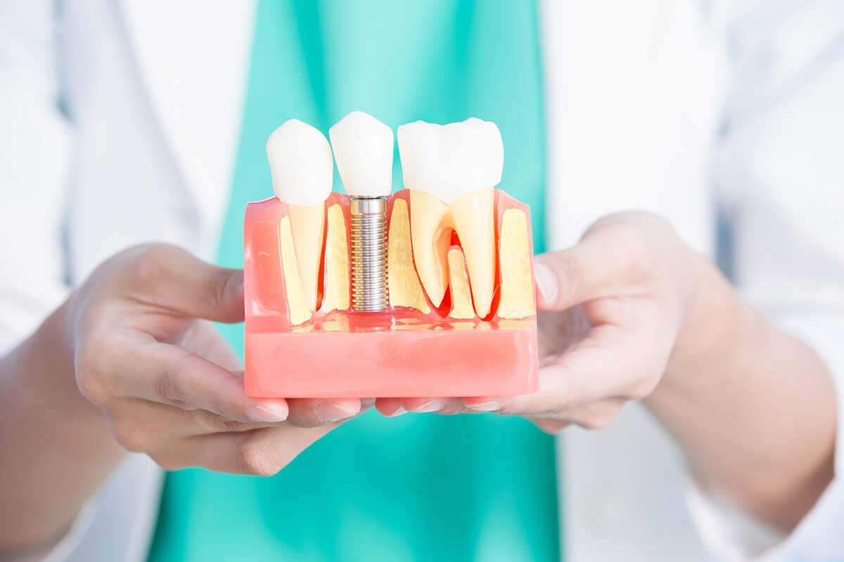 How Long Does A Dental Implant Procedure Take? Rockland County