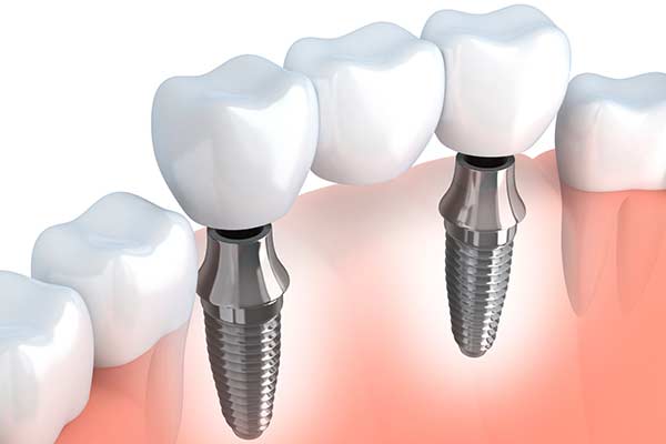 Implant Supported Bridges Guided Implant Placement in Pomona & Brooklyn