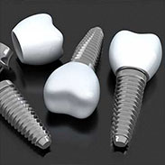 Dental Implants in NY