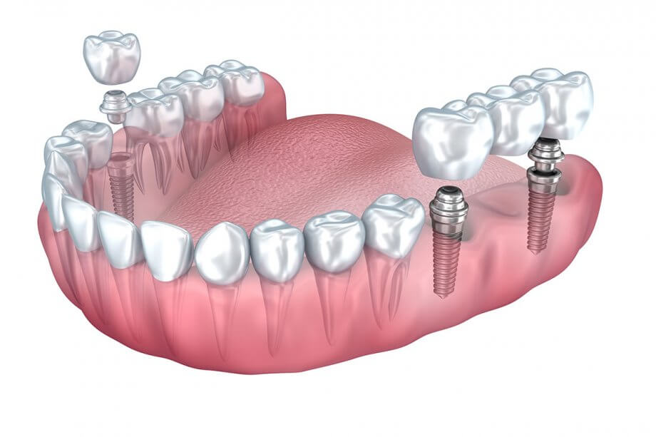 Dental Implants in Murrieta, CA