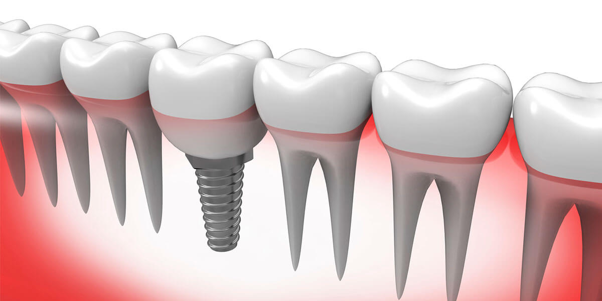 Single Dental Implants in Pomona & Brooklyn