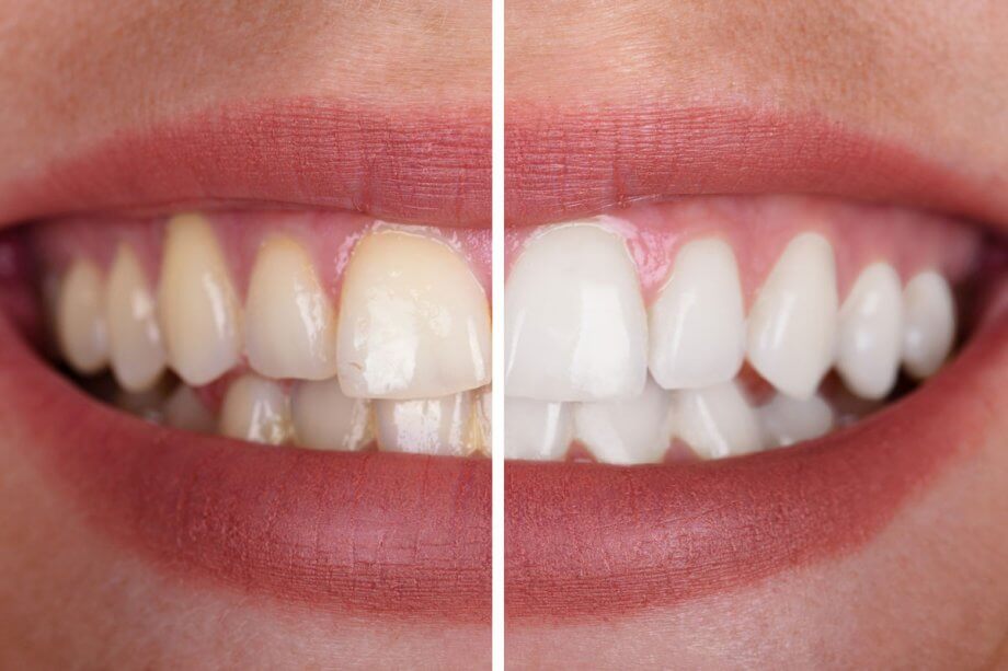 before and after photos of whitening a woman's teeth
